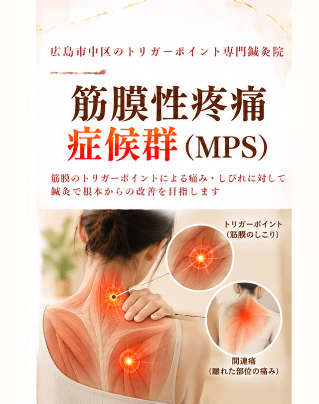 筋膜性疼痛症候群トリガーポイント療法