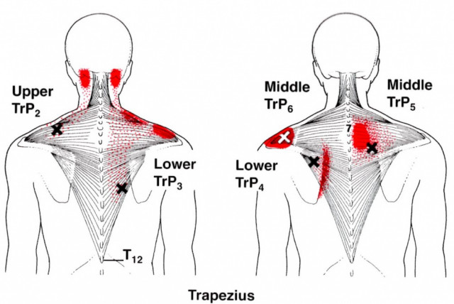 トリガーポイント（首の筋肉、筋膜の問題）
