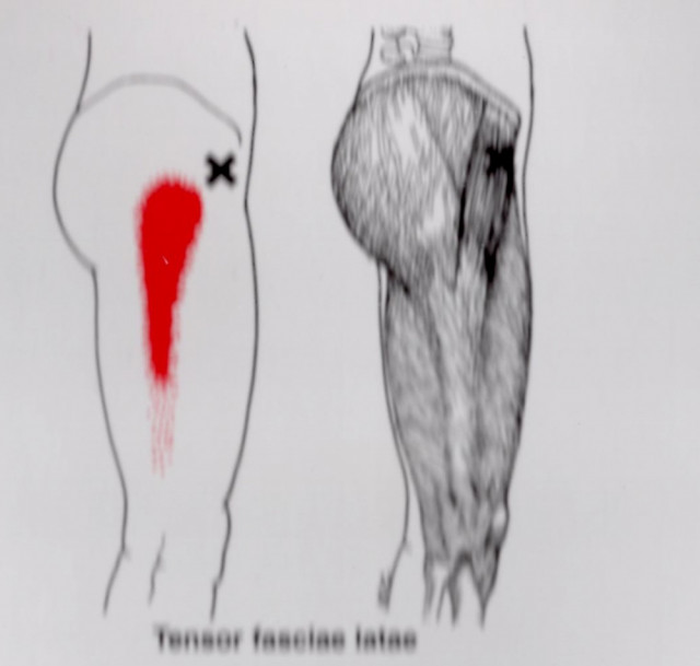 股関節の痛みのトリガーポイント