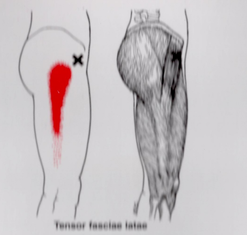大腿筋膜張筋トリガーポイント