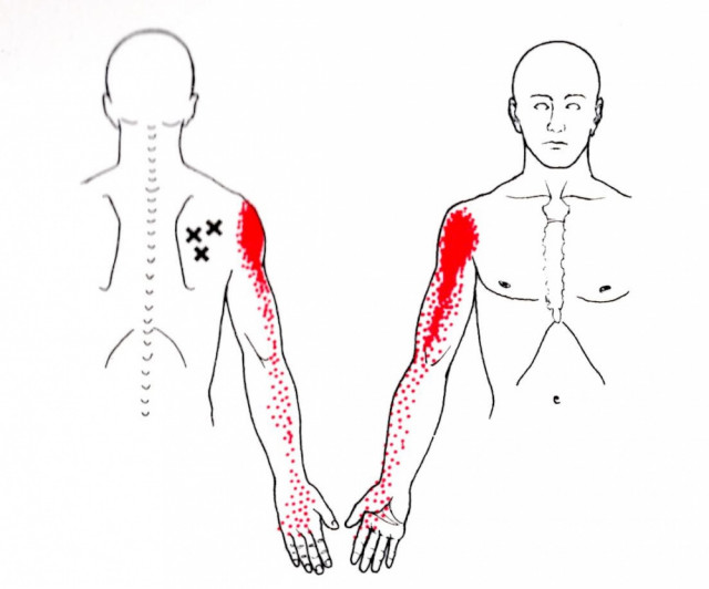 肩のトリガーポイントによる腕痛