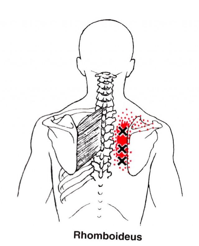 肩甲骨の痛みのトリガーポイント