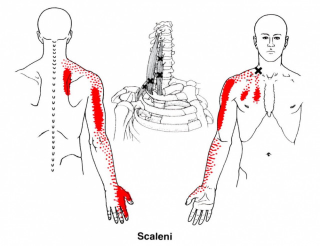肩甲骨から腕にかけての痛みはトリガーポイントからの関連痛
