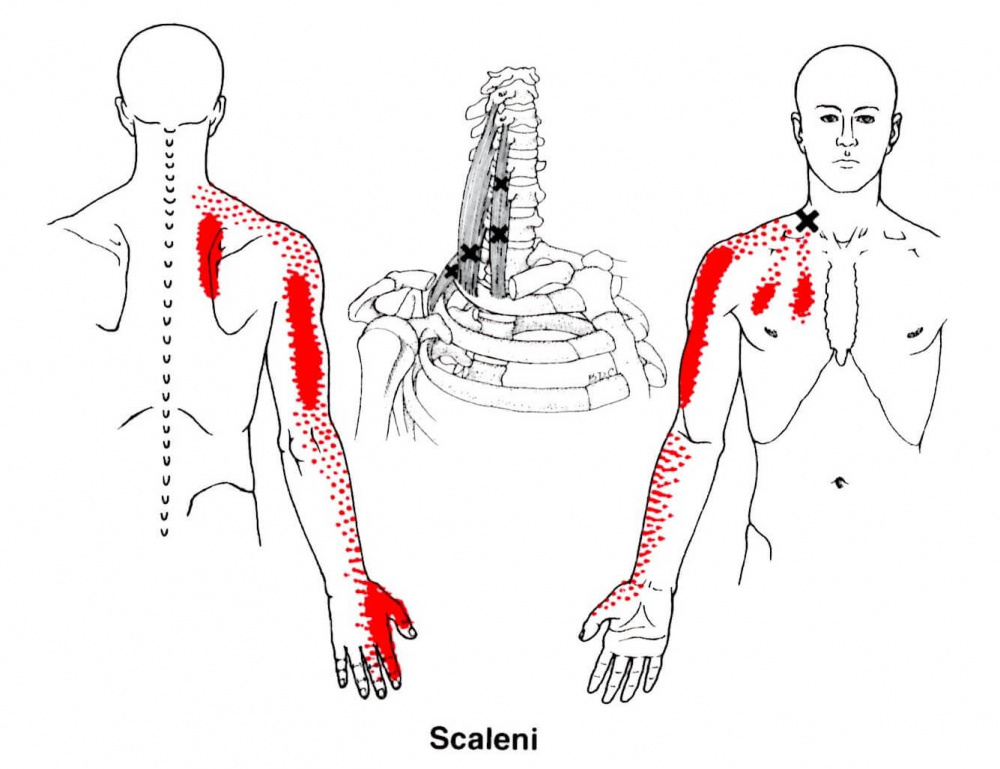 腕のしびれと痛みに関係するトリガーポイント