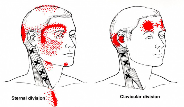 後頭部や首の付け根の痛みに関係するトリガーポイント