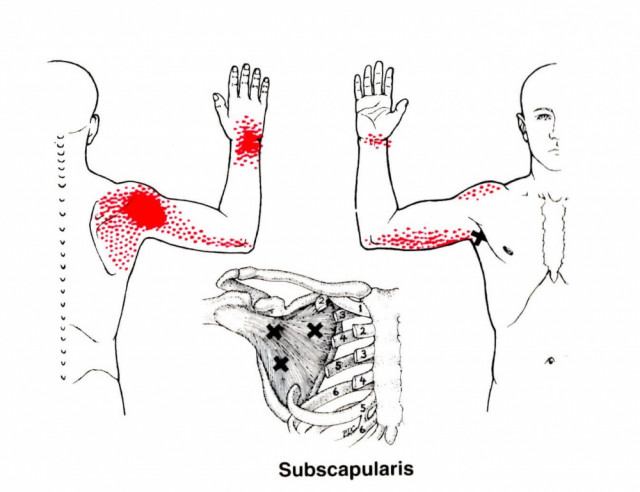 腕のしびれと痛みに関係するトリガーポイント