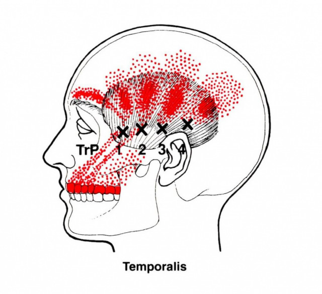 頭痛の原因となる側頭部のトリガーポイント