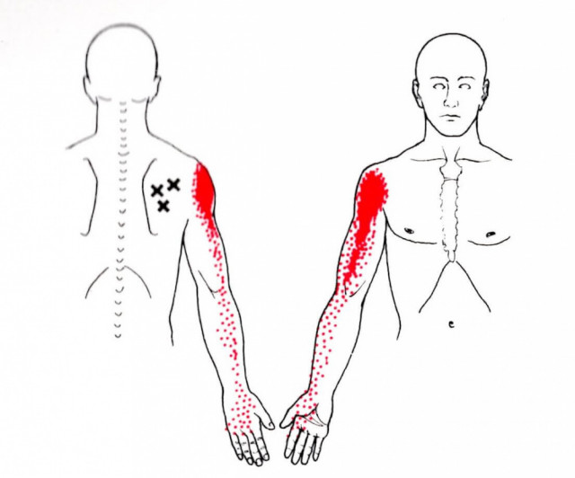 肩甲骨から腕にかけての痛みはトリガーポイントからの関連痛