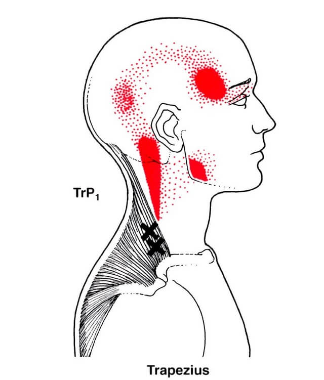 首の痛みに対する鍼治療