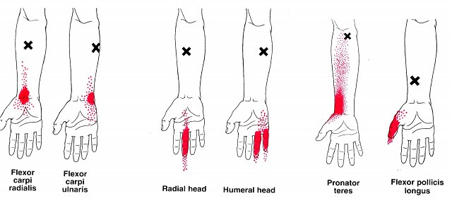 手首の痛みに対する鍼治療