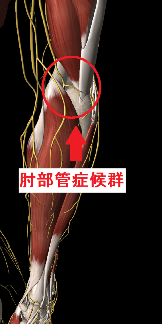肘部管症候群の原因と症状