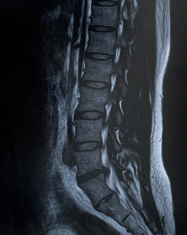 腰部脊柱管狭窄症の原因と症状
