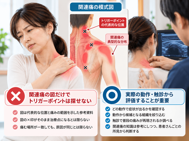 4.痛む場所から関連痛の図だけでトリガーポイントは探せない
